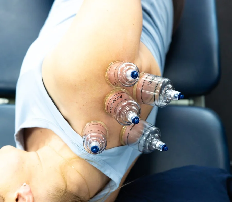 Cupping therapy on a patient's shoulder at Vitality Therapy and Performance
